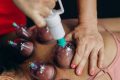 pexels-photo-27730433-27730433 Close-up of cupping therapy on a woman's back, focusing on muscle recovery and relaxation.